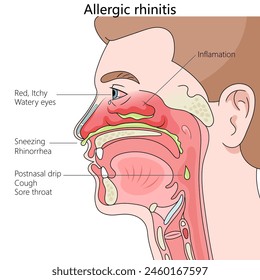 Rinitis alérgica, que muestra síntomas como estornudos, ojos llorosos y diagrama de inflamación Ilustración vectorial esquemática dibujada a mano. Ilustración educativa de ciencias médicas