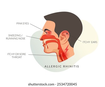 Allergic rhinitis Symptoms - Sneezing - Running Nose - Stock Illustration as EPS 10 File