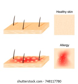 Allergy. Hives (urticaria) are a common allergic symptom. skin rash. healthy skin and allergic reactions. top and side view