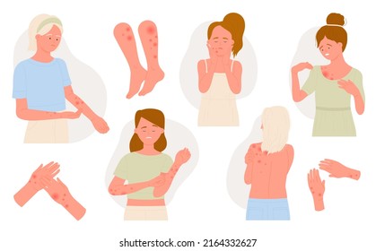 Allergy On Body Skin Set, Medical Infographic Flat Vector Illustration. Cartoon Sick Girl Patient With Allergic Symptoms Of Itch, Inflammation, Irritation Red Spots. Dermatology, Skincare Concept
