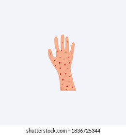 18,277 Hand rashes Images, Stock Photos & Vectors | Shutterstock