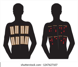 Allergy Patch Skin Tests Vector Illustration Stock Vector (Royalty Free ...