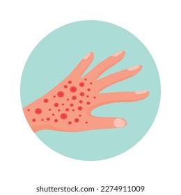 Allergy symptom flat icon with hand covered with allergic red rashes vector illustration