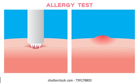 Allergy Test Vector