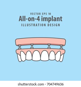 All-on-4 implant illustration vector on blue background. Dental concept.