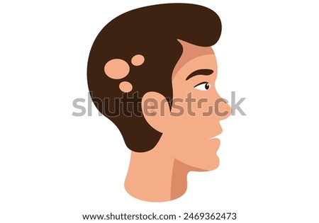 Alopecia areata is an autoimmune condition causing patchy hair loss on the scalp, face, and body. It occurs when the immune system attacks hair follicles, leading to sudden, unpredictable bald spots.