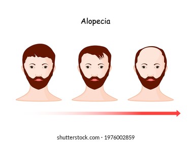 alopecia. baldness. hair loss from part of the head of a man along time. vector illustration human's head and time line