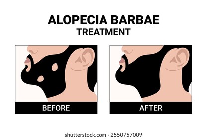 Tratamento da alopecia barbae antes e depois