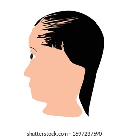 Alopecia hair. Baldness of hair on the head. Telogen Alopecia. Infographics. Vector illustration on isolated background.