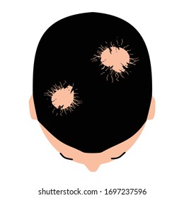 Alopecia hair. Baldness of hair on the head. Alopecia areata. Infographics. Vector illustration on isolated background.