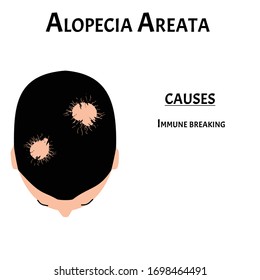 Alopecia hair. Baldness of hair on the head. Alopecia areata causes. Infographics. Vector illustration on isolated background.