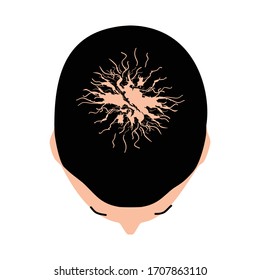 Alopecia hair. Baldness of hair on the head. Androgenic alopecia. Infographics. Vector illustration on isolated background.