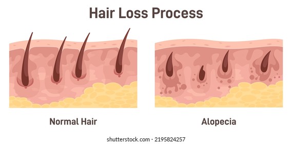 Alopecia. Hair loss, balding process. Cross-section anatomical structure of skin with hair folicule. Flat vector illustration