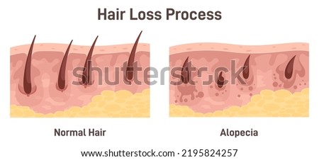 Alopecia. Hair loss, balding process. Cross-section anatomical structure of skin with hair folicule. Flat vector illustration