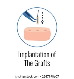 Alopecia hair transplantation composition with infographic image of hair restoration procedures with text vector illustration