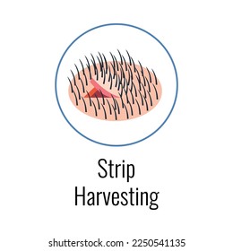 Alopecia hair transplantation composition with infographic image of hair restoration procedures with text vector illustration