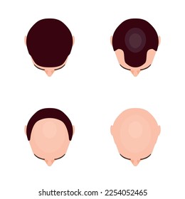 Alopecia hair transplantation composition with infographic image of hair restoration procedures vector illustration