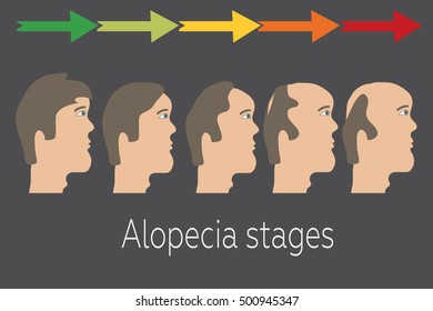 Alopecia stages set. Front view of a man losing hair. Male baldness. Male hair loss pattern.  Hair care concept. Vector illustration.