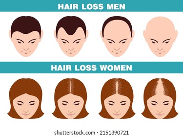 Alopecia Stages Set Hair Loss Stages Stock Vector (Royalty Free ...