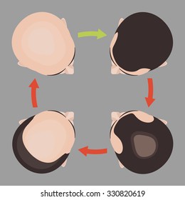 Alopecia stages set. Top view portrait of a man before and after hair treatment and  transplantation. Male baldness pattern cycle. Isolated vector illustration.