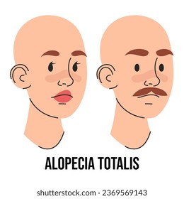 Alopecia totalis vector isolated. Male and female character suffering from hair loss. Completely bald head. Medical condition. Baldness, scalp disease.