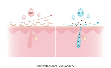 Características de los ácidos alfa hidroxi y beta hidroxi ácidos Ilustración vectorial sobre fondo blanco. AHA exfolia la superficie de la piel y es soluble en agua. El BHA penetra profundamente en el poro y es soluble en aceite.