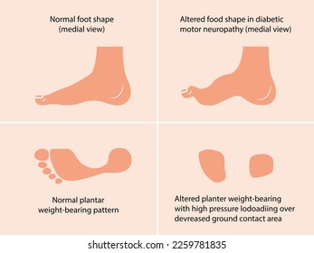 Altered shape the foot caused by diabetic motor neuropathy  Created in Adobe Illustrator  Contains gradient meshes  EPS 10 