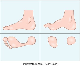 Altered shape the foot caused by diabetic motor neuropathy  Created in Adobe Illustrator   Contains gradient meshes   EPS 10 