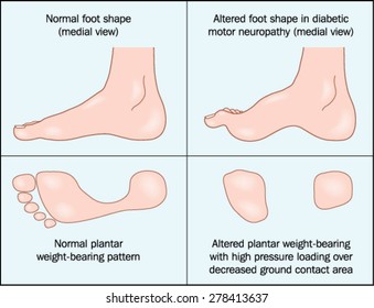 Altered shape the foot caused by diabetic motor neuropathy  Created in Adobe Illustrator   Contains gradient meshes   EPS 10 