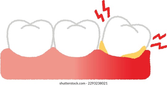 Alveolar pyorrhea is a condition in which pus leaks from the alveolar bone that supports the teeth. Chronic periodontitis refers to advanced periodontal disease.