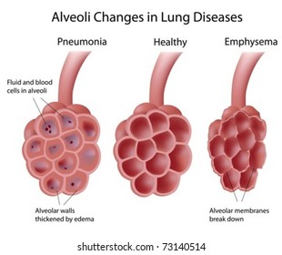 Alveoli In Lung Diseases