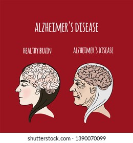 ALZHEIMER DISEASE Dementia Medicine Vector Illustration