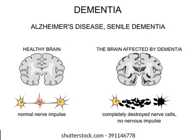 Alzheimer s disease, senile changes of the brain