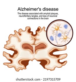 Alzheimer's disease. disease associated with neurofibrillary tangles, and loss of neuronal connections in the brain. human brain with Alzheimer's disease. Close-up of neurons with amyloid plaques