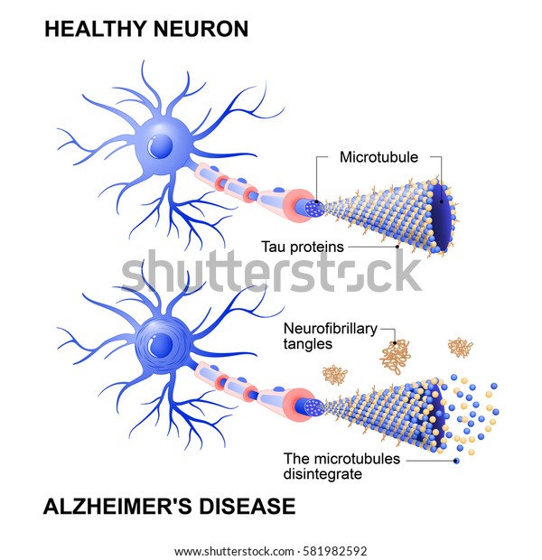 Alzheimer\'s disease is the change in tau\
protein that results in the breakdown of microtubules in brain\
cells. Mechanism of disease. two neurons: healthy cell and neuron\
with Alzheimers. Tau\
hypothesi