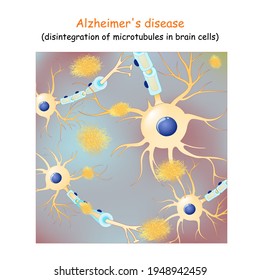 Alzheimer's Disease. Dementia. Vector Background With Neurons And Amyloid Plaques (tau Protein That Lead To The Disintegration Of Microtubules In Brain Cells).