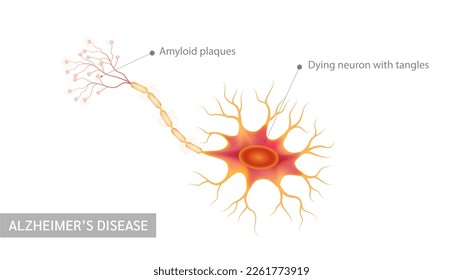 Alzheimer's disease. Dying neuron with tangles and Amyloid plaques. Neural net structure cell anatomy model isolated on white background. Medicine and science concept. 3D Vector.