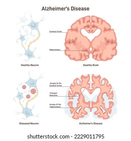 Enfermedad de Alzheimer. Sección transversal del cerebro humano, saludable y enfermo. Neurona dañada con placas amiloides. Ilustración vectorial plana