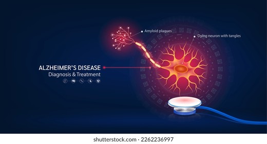 Alzheimer's disease. Human nerve model float away from stethoscope. Dying neuron with tangles and Amyloid plaques. Doctor diagnosis treatment. Banner design for pharmacy clinic. 3d Vector.