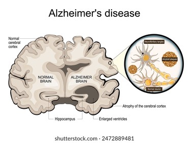 Alzheimer's disease. Neurodegeneration. Cross section of Alzheimer brain, Atrophy of the cerebral cortex, Enlarged ventricles and Hippocampus. Neurons, Neurofibrillary tangles and Amyloid plaques