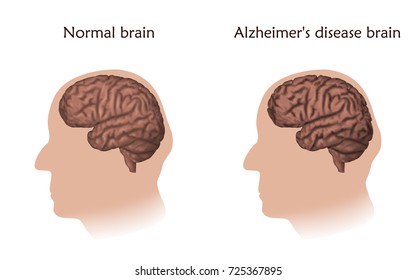 Alzheimer's disease poster, banner. Vector medical illustration. White background, silhouette of old man head, anatomy image of comparison, damaged and normal human brains.