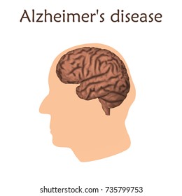 Alzheimer's disease poster, banner. Vector medical illustration. White background, pink silhouette of old man head, anatomy image of damaged human brain.