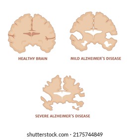 Alzheimers Disease Stages Development Pathology Indication Stock Vector ...