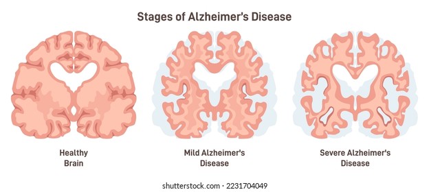 Alzheimer's disease stages. Human brain cross section, affected with progressive neurodegenerative disease. Damaged neuron with amyloid plaques. Flat vector illustration