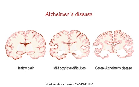 Alzheimer's, is a neurodegenerative disease. dementia. comparison and difference between Healthy brain, Severe Alzheimer's disease, and Mild cognitive difficulties. Vector illustration