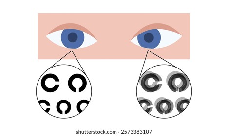 Amblyopia or lazy eye disease. Eyesight check up in the ophthalmology center. Landolt c optometry exam. Vision diseases, diagnostic and treatment. Human vision problem correction vector illustration