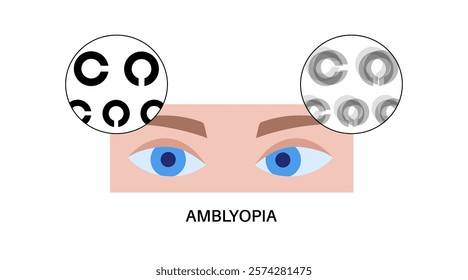 Amblyopia or lazy eye disease. Eyesight check up in the ophthalmology center. Landolt c optometry exam. Vision diseases, diagnostic and treatment. Human vision problem correction vector illustration