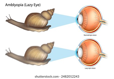 Amblyopia or Lazy Eye. Lazy eye vision and Normal eye vision