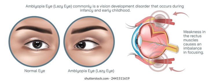 Amblyopia, often referred to as lazy eye is a condition characterized by reduced vision in one or both eyes that is not due to any structural abnormalities of the eye vector illustration.