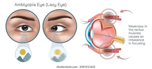 Amblyopia, often referred to as lazy eye is a condition characterized by reduced vision in one or both eyes that is not due to any structural abnormalities of the eye vector illustration.